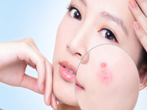 Hướng dẫn cách trị mụn viêm tại nhà đơn giản và hiệu quả
