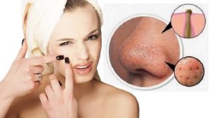 Mụn đầu đen là gì? Nguyên nhân và cách trị mụn đầu đen