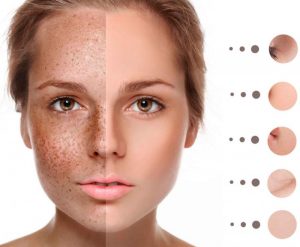Tàn nhang: Nguyên nhân và cách điều trị hợp lý