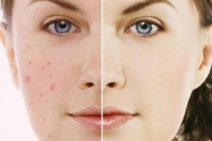 Phương pháp lăn kim kết hợp tế bào gốc trị thâm có thực sự hiệu quả?