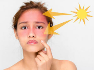 Tìm hiểu nguyên nhân và cách chữa cháy nắng da