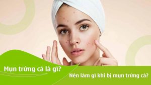 Mụn trứng cá là gì? Nên làm gì khi bị mụn trứng cá?