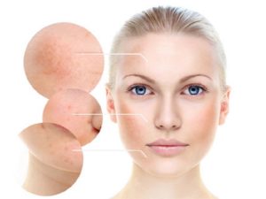 Tế bào gốc trị nám có thực sự hiệu quả hay không?