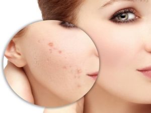 Tế bào gốc trị sẹo rỗ giúp tái sinh làn da mịn màng