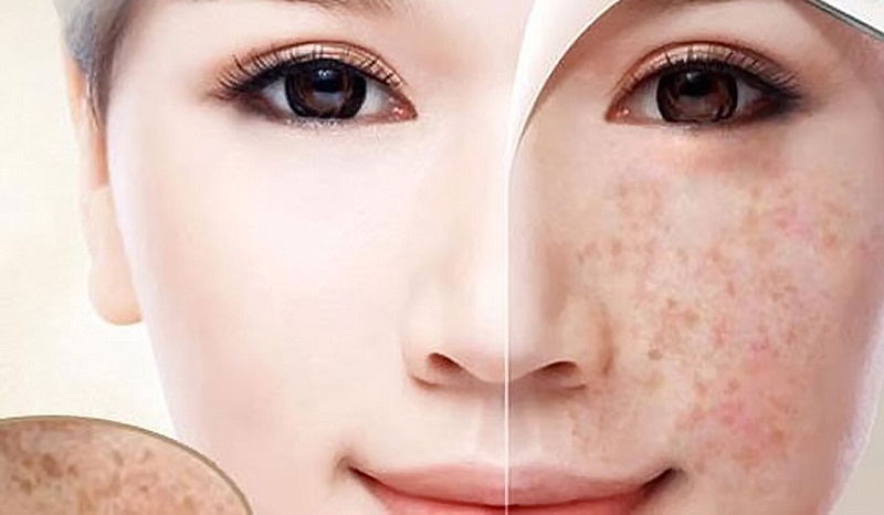 cách trị nám tàn nhang 