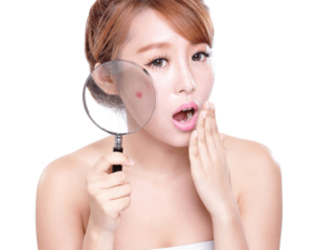 Tế bào gốc đặc trị mụn – Trào lưu chăm sóc da kiểu mới