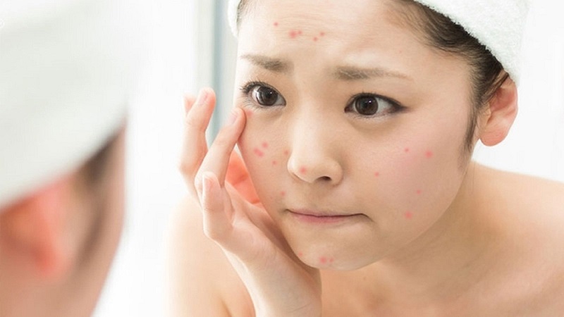 trị mụn da dầu mùa hè