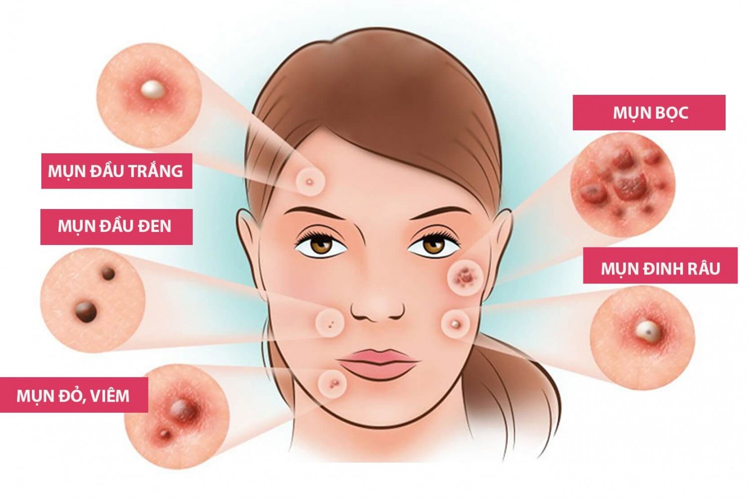 trị mụn đầu trắng