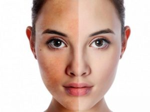 6 vấn đề về da vào mùa hè thường gặp ở phái nữ và cách khắc phục