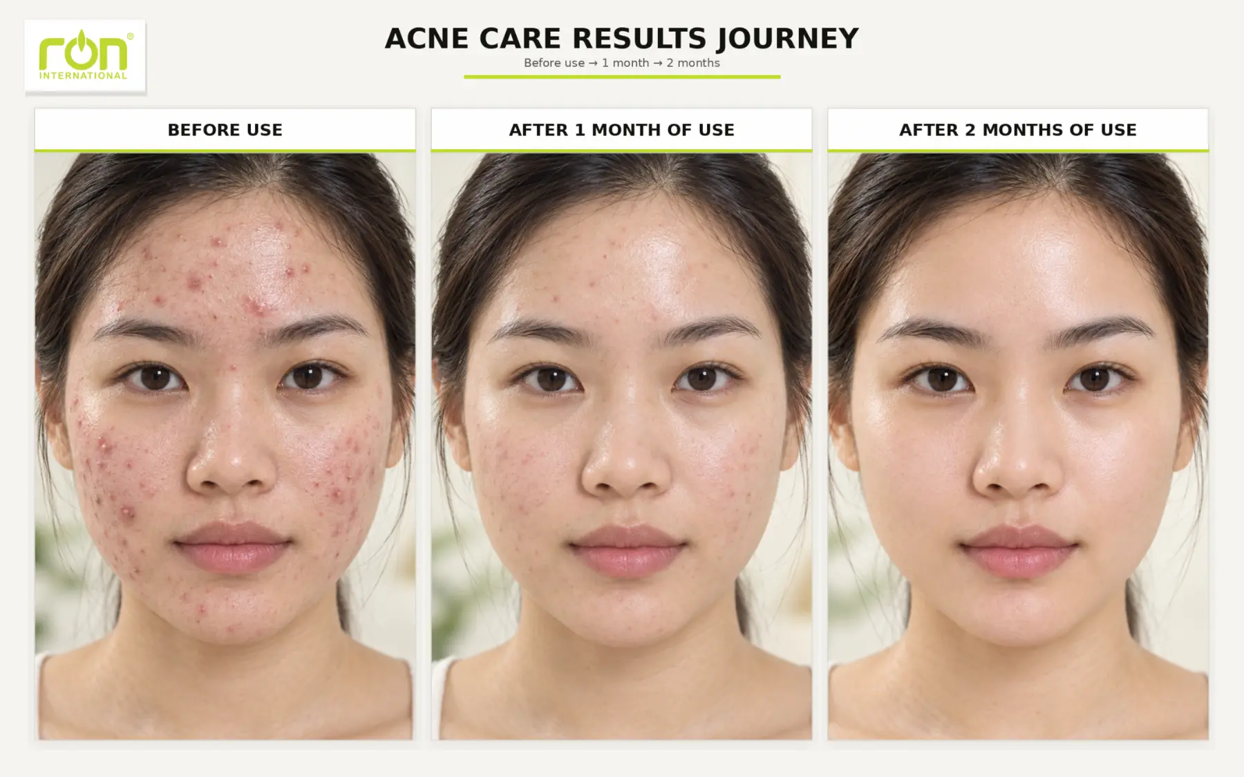 Hình minh họa hành trình chăm sóc da dễ nổi mụn được phóng lớn