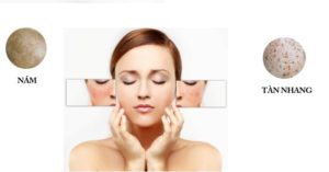 cách trị nám tàn nhang